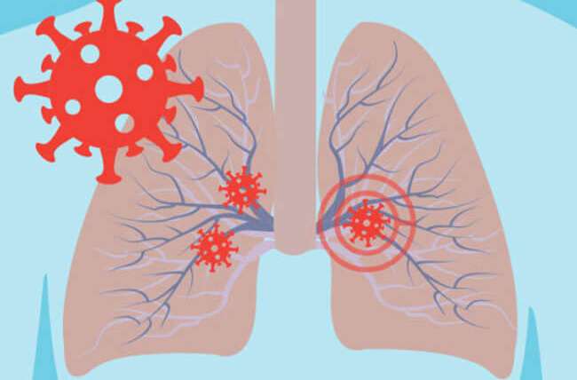 Damage Coronavirus (COVID-19) Can Do to Your Lungs