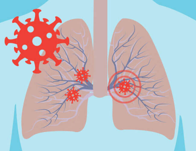 Damage Coronavirus (COVID-19) Can Do to Your Lungs