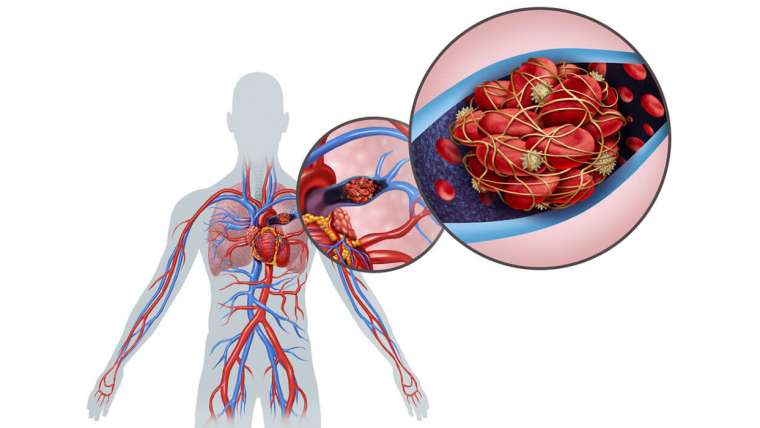 PULMONARY EMBOLISM (Blood Clots in the Lungs)