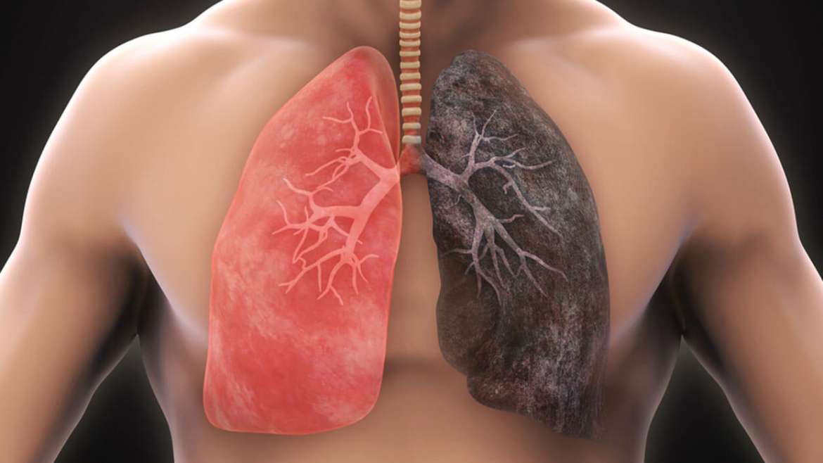 Here is everything you need to know about COPD( Chronic Obstructive Pulmonary Disease)