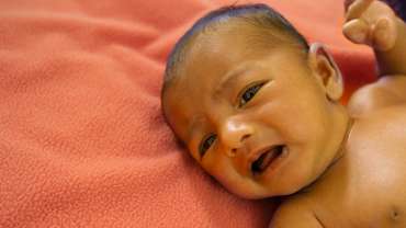 New Born Jaundice