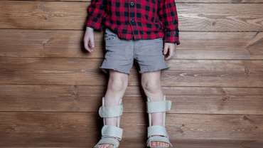 Rickets Treatment