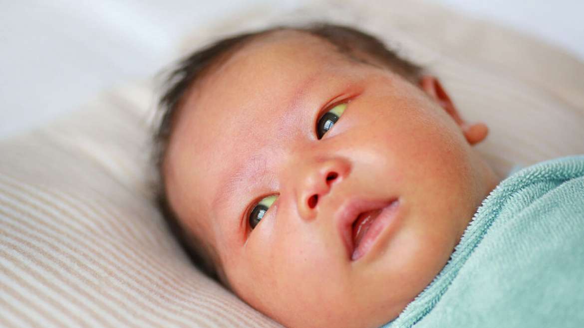 Jaundice: Causes, symptoms, and treatments