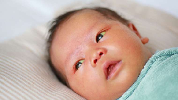 Jaundice: Causes, symptoms, and treatments