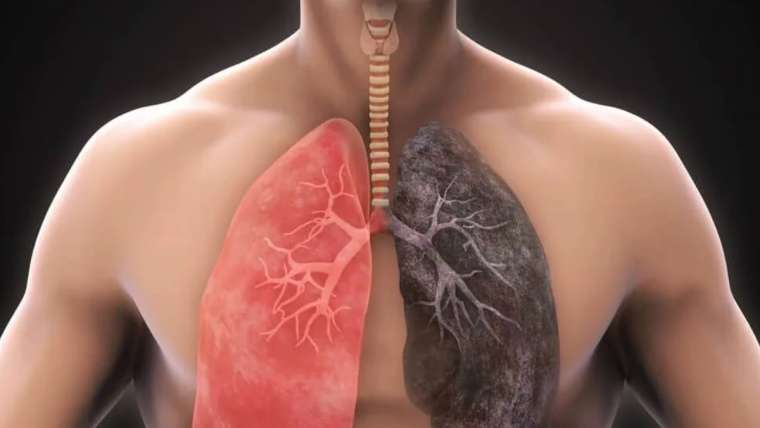 Chronic Obstructive Pulmonary Disease: Symptoms, Causes & Treatment